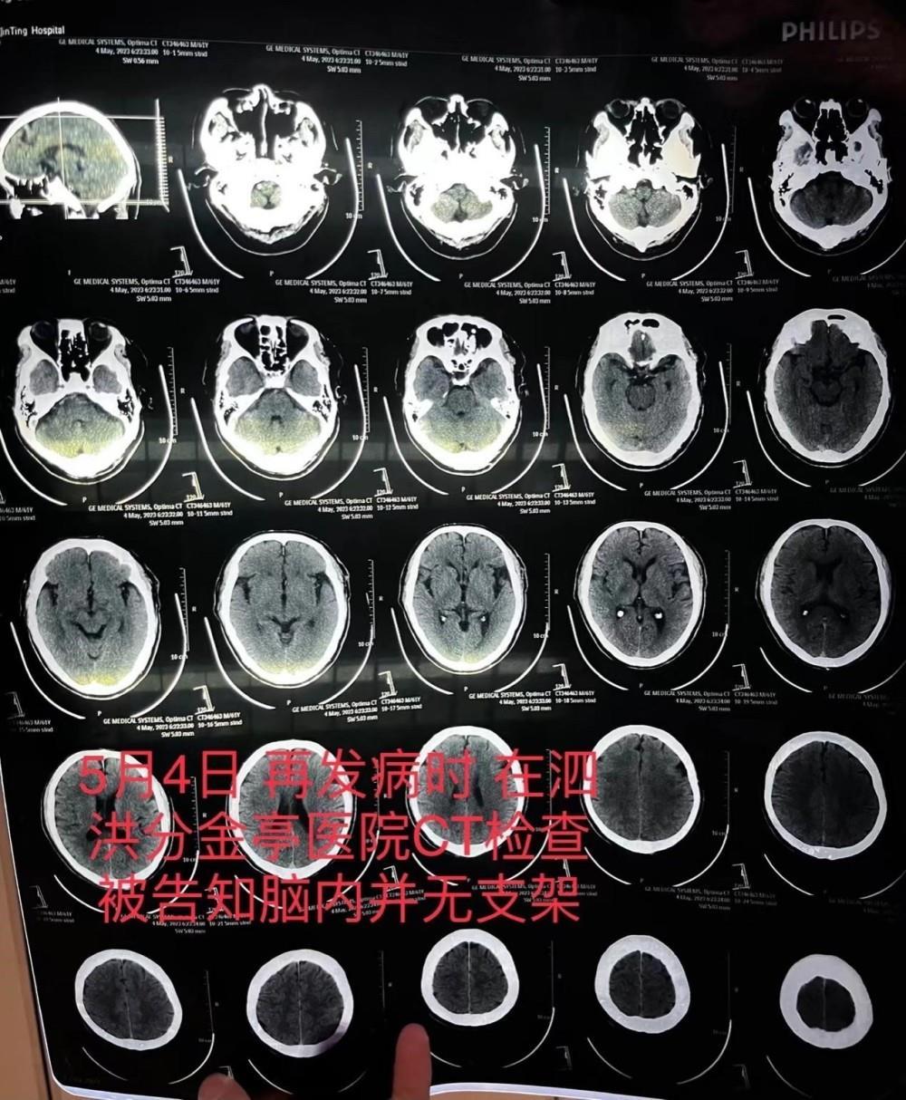 江苏一患者因脑梗去世，医生承认支架植入失败，病历中却谎称手术成功