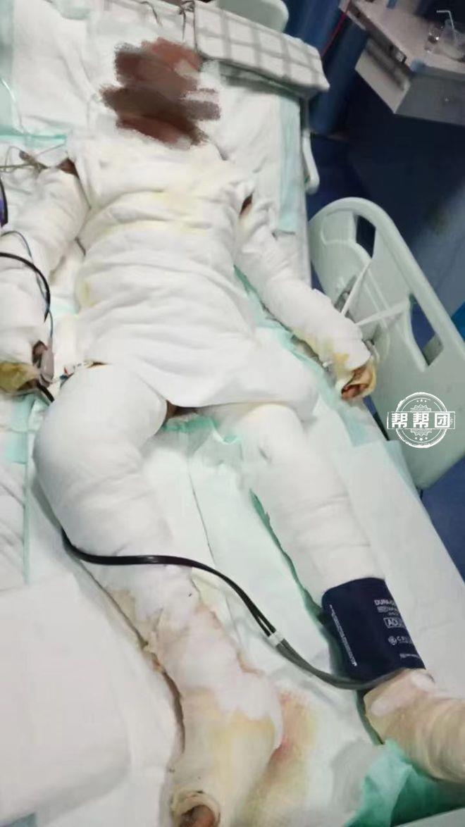 全身包满纱布的父亲躺在ICU里,用嘴型告诉女儿:先救妈妈!