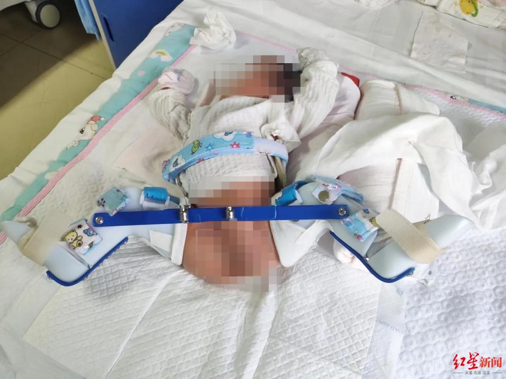 剖宫产时主刀医生把孩子大腿掰骨折却不告知家属？院方：医生已停职