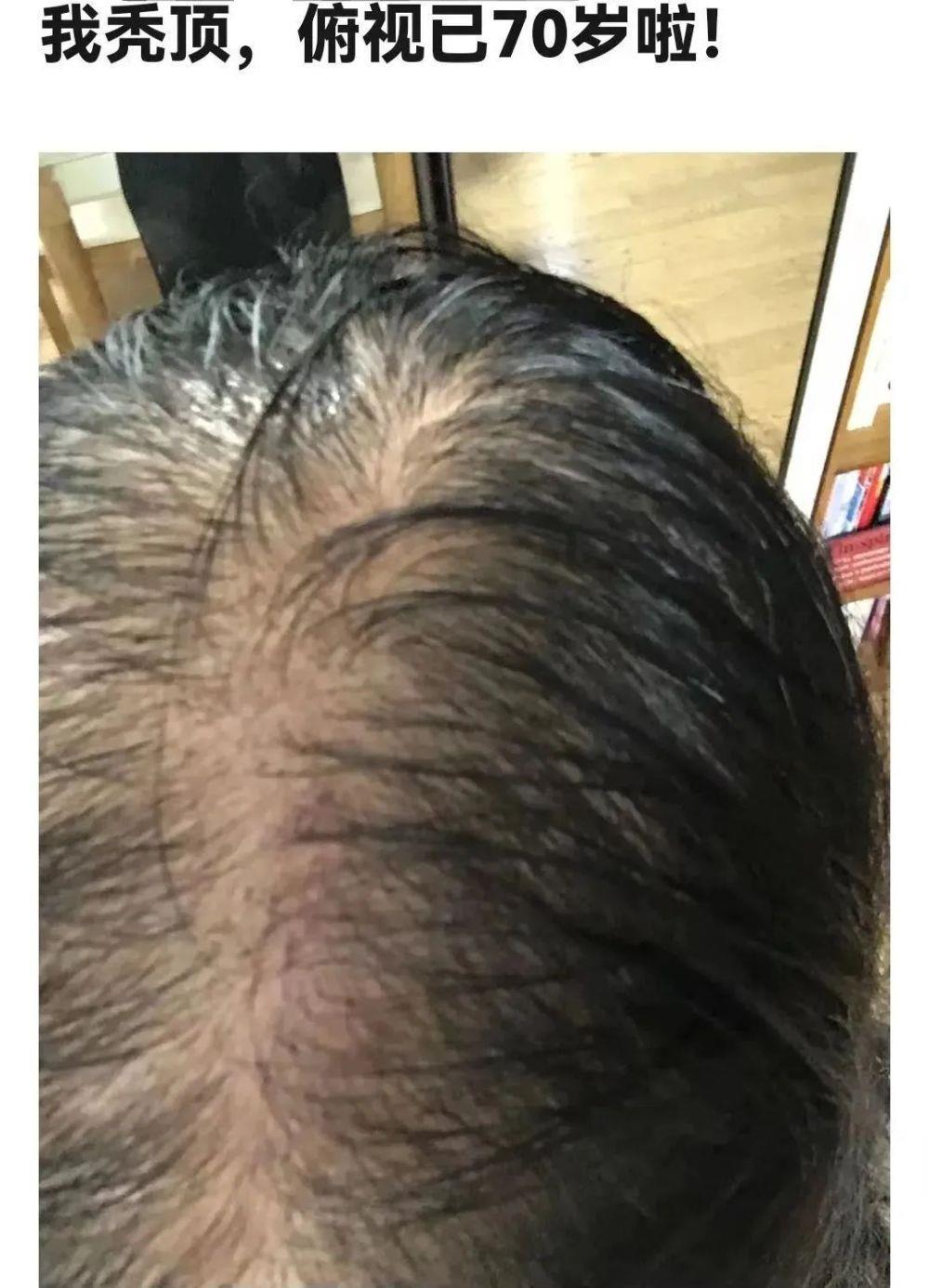 秃头人最后的倔强：假发不被发现