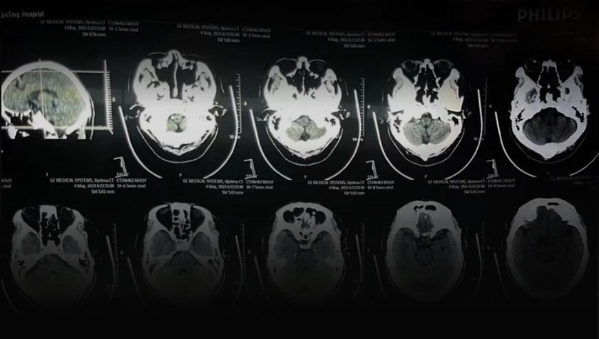 老人脑梗去世医生未植入支架却隐瞒：家属称已妥善处理，卫健委未回应