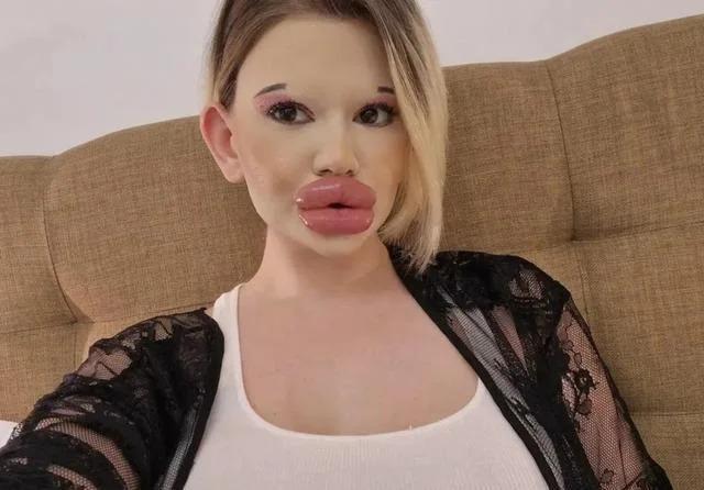 梦想当芭比！25岁网红整容43次变梁朝伟同款香肠唇