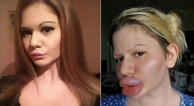 梦想当芭比！25岁网红整容43次变梁朝伟同款香肠唇