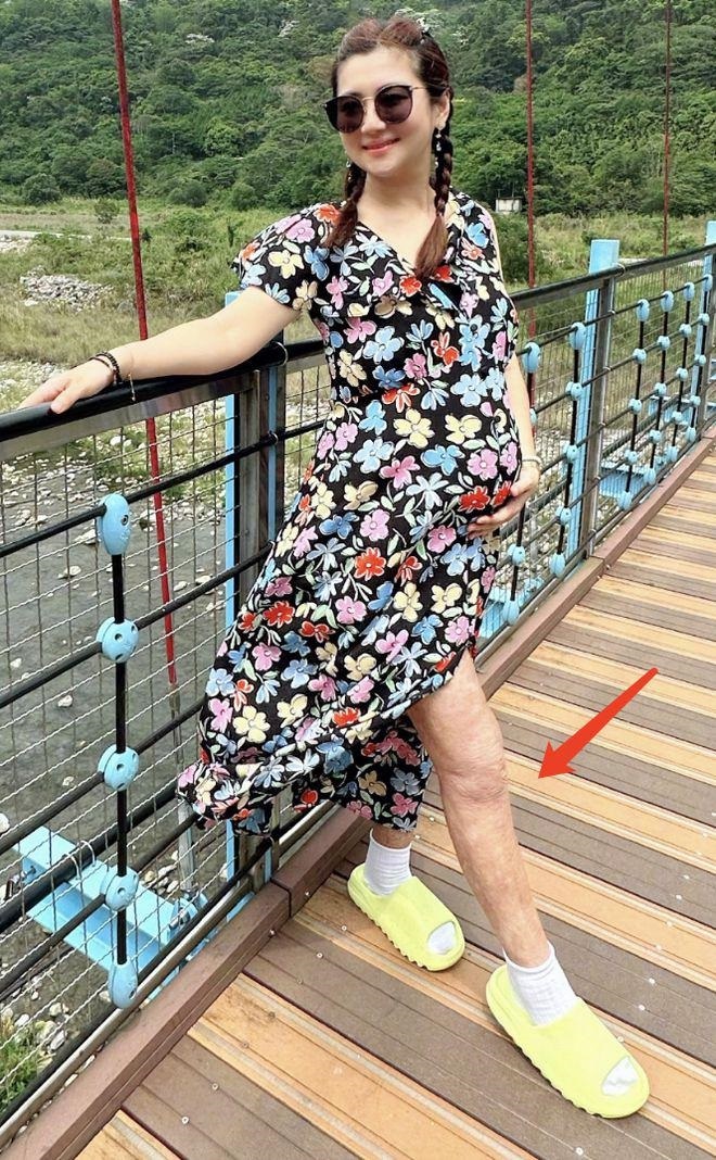 Selina挺孕肚拍大片：手臂疤痕明显 孕期水肿严重