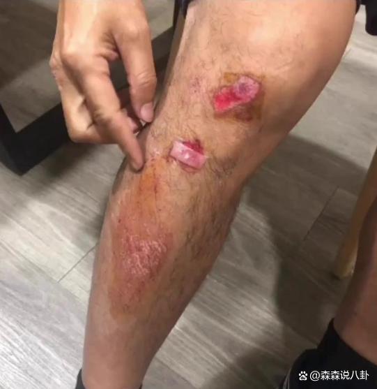 60岁吴宗宪录节目不慎摔伤，手脚及嘴角擦伤出血他还在笑
