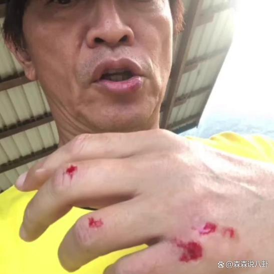 60岁吴宗宪录节目不慎摔伤，手脚及嘴角擦伤出血他还在笑