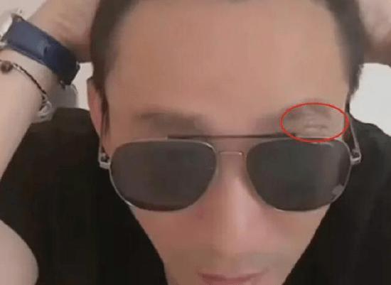 汪小菲直播罕提大S 戴墨镜眼角缝针疑似整容