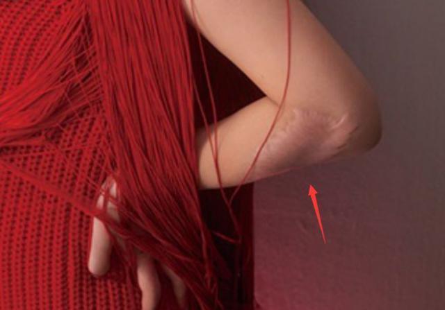 Selina挺孕肚拍大片：手臂疤痕明显 孕期水肿严重