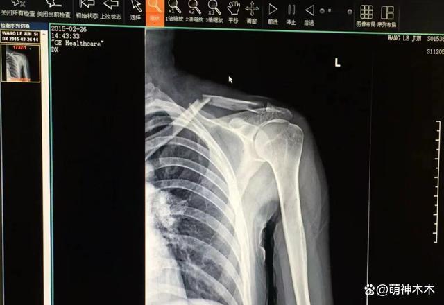 《伪装者》女主开撕胡歌！被撞断锁骨不让说，难忍被网暴十年