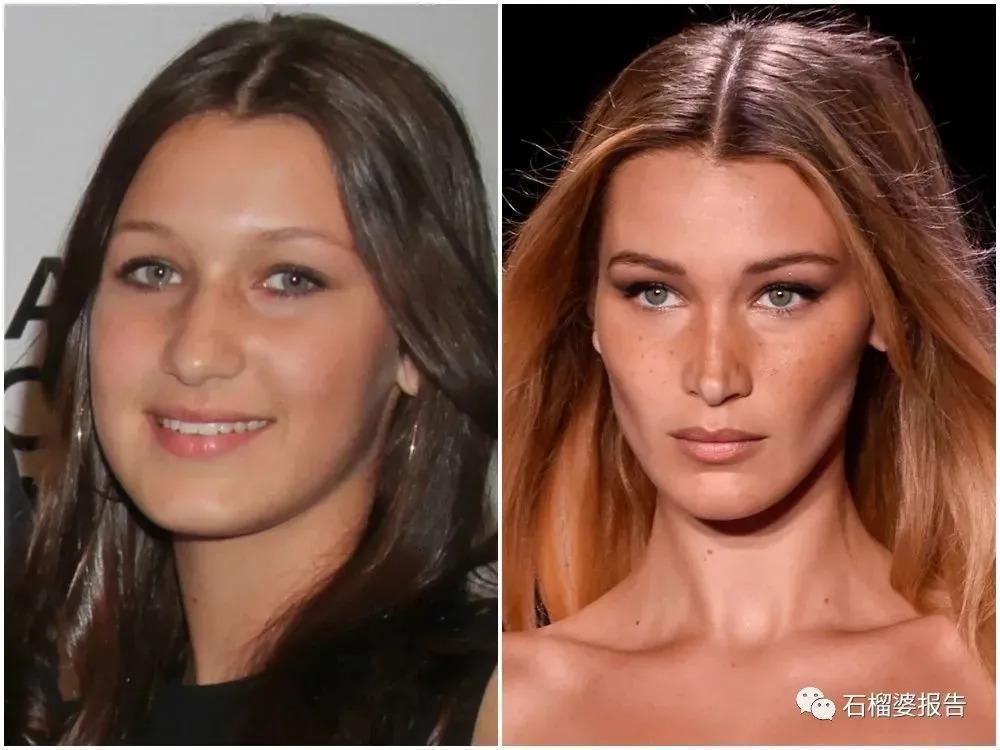 好莱坞集体瘦脸，又有了新的整形重点？