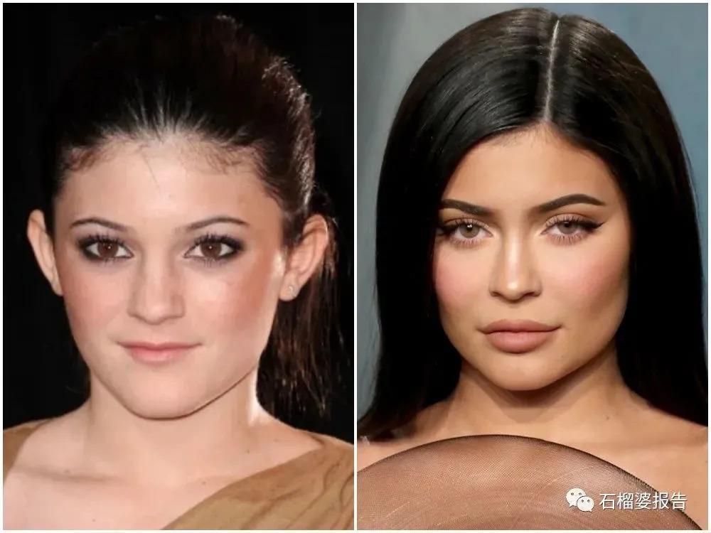 好莱坞集体瘦脸，又有了新的整形重点？