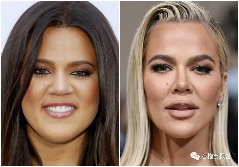 好莱坞集体瘦脸，又有了新的整形重点？