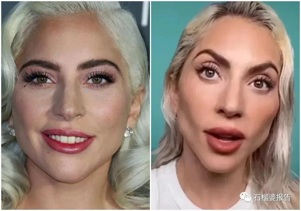 好莱坞集体瘦脸，又有了新的整形重点？