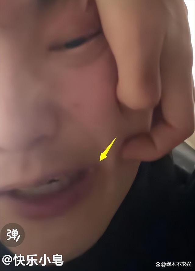 29岁快乐小赵因遗传病去世！原生家庭太窒息，最后露面暴瘦烂嘴！