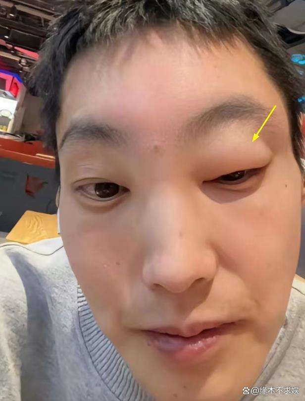 29岁快乐小赵因遗传病去世！原生家庭太窒息，最后露面暴瘦烂嘴！
