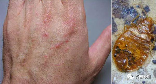 巴黎嗜血臭虫已到亚洲！韩国大学寝室商店健身房现大面积虫卵，香港地铁也遭侵袭？！