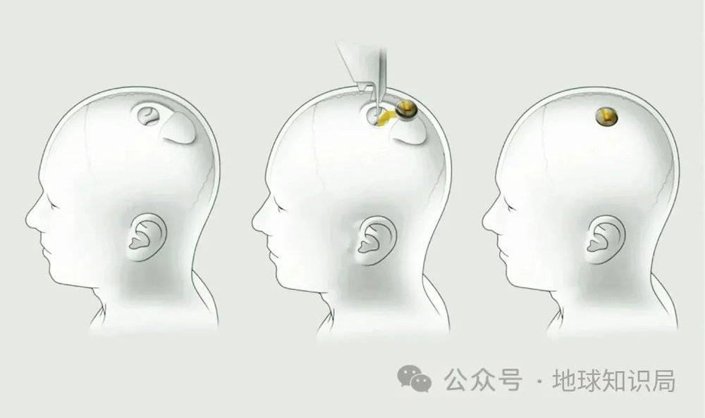 美国最新技术来了，专搞人的脑子