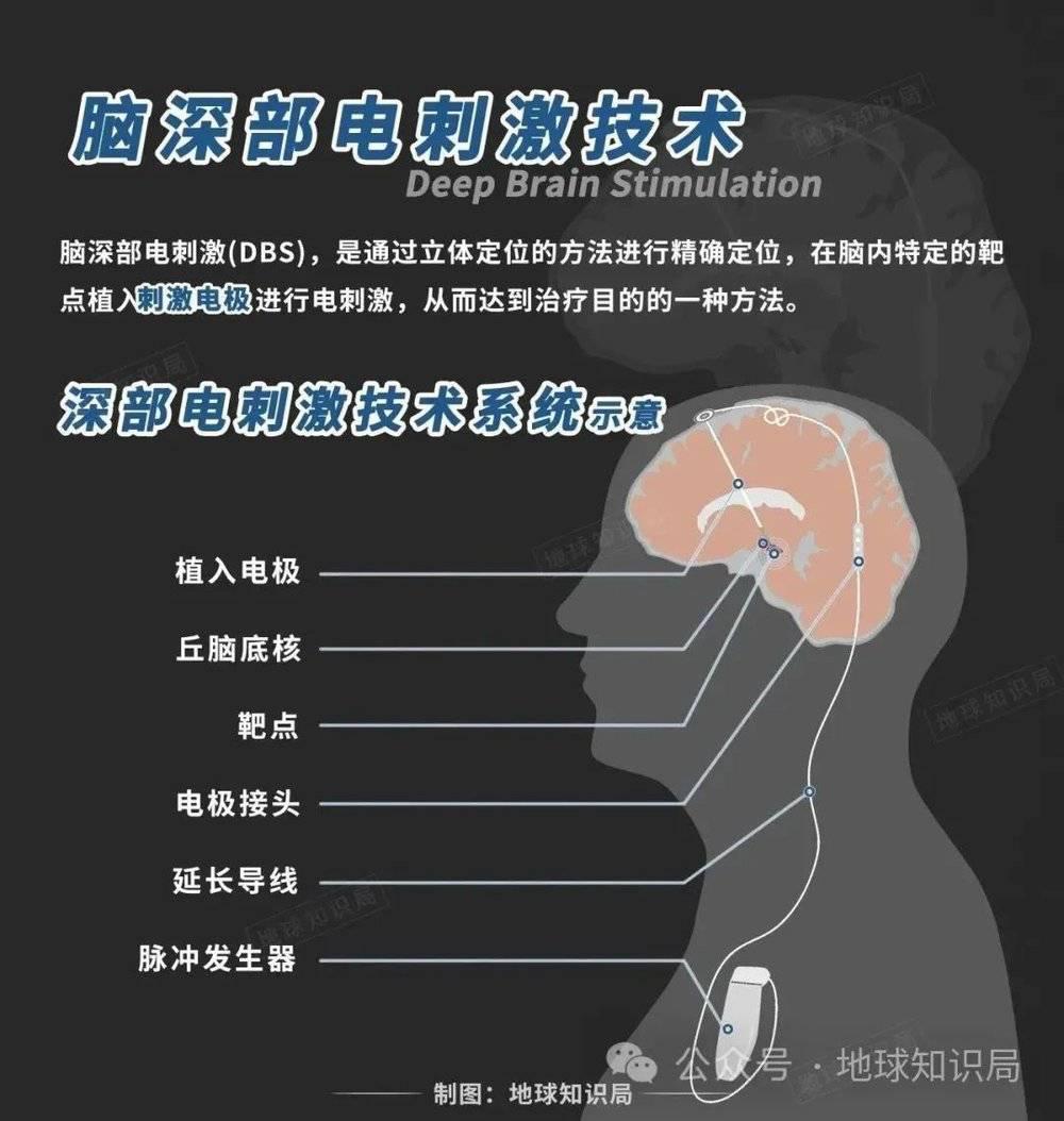 美国最新技术来了，专搞人的脑子