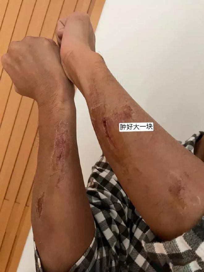 林峰受伤！拄拐现身曝受伤原因，吴千语施伯雄新疆秀恩爱