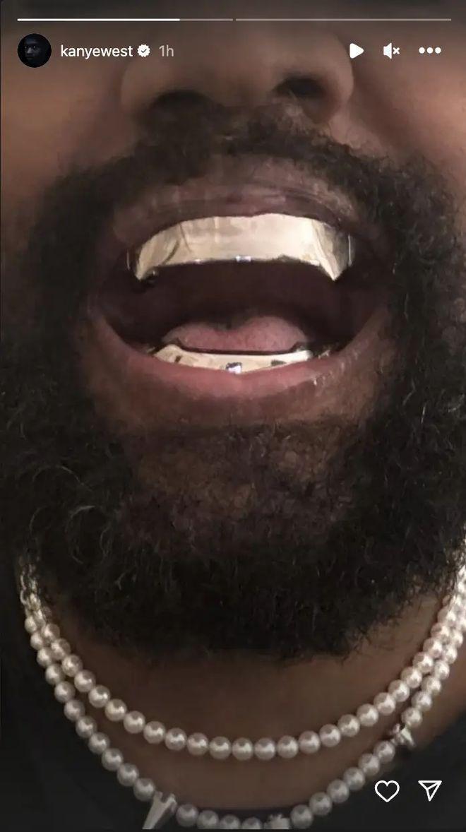 花了600w！坎爷Kanye换了一副钢牙