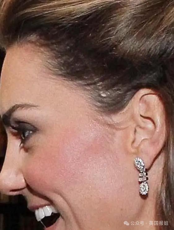 英王室危？查尔斯入院，同天曝凯特做腹部大手术？