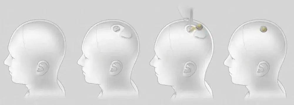 今天，马斯克往人脑里塞了块思维读取芯片。