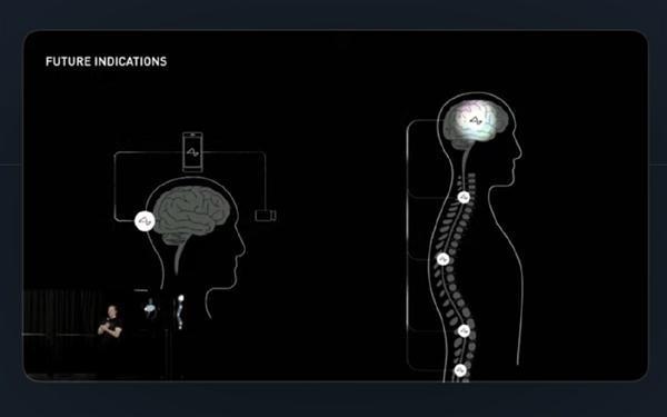 重大突破！马斯克宣布首例人类大脑芯片植入：恢复良好