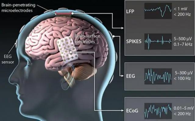 意念控制成真？人类首例脑机接口手术完成