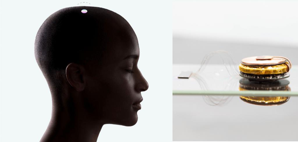 马斯克分享Neuralink脑机接口首位人体受试者新进展